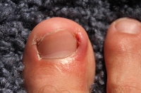 Common Reasons Why an Ingrown Toenail Can Develop