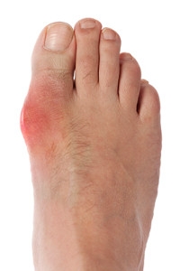 Excess Uric Acid May Cause Gout