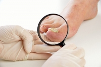 How Can Toenail Fungus Be Prevented?